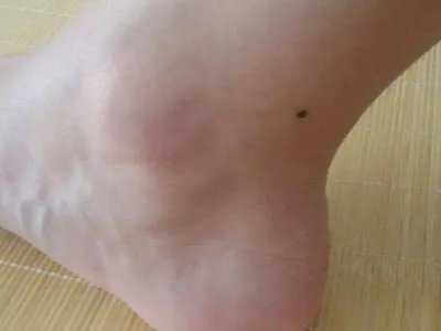 交界痣黑痣图片