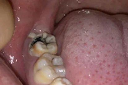 拔牙后七天窟窿恢复图