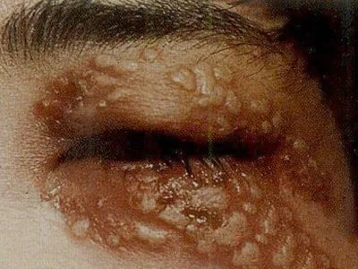 单纯疱疹水疱图片