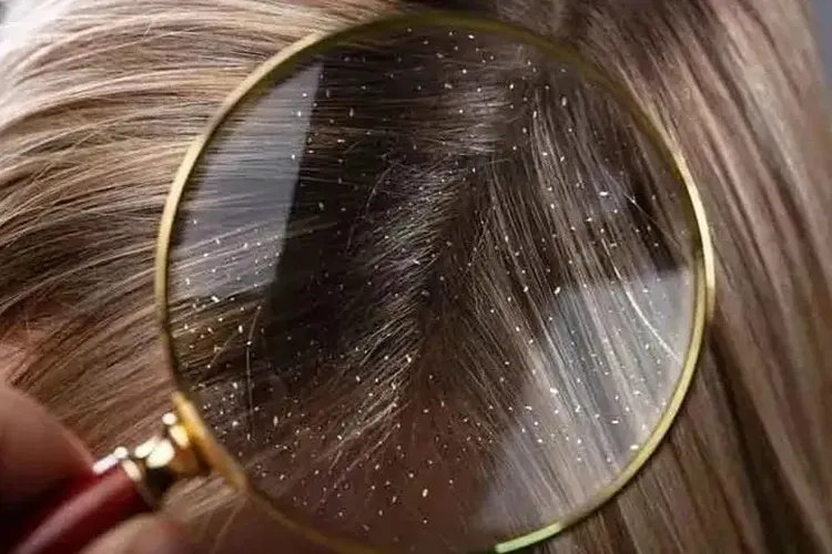 头皮屑症状图片