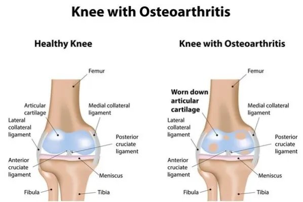 盘点常见骨科疾病的运动处方