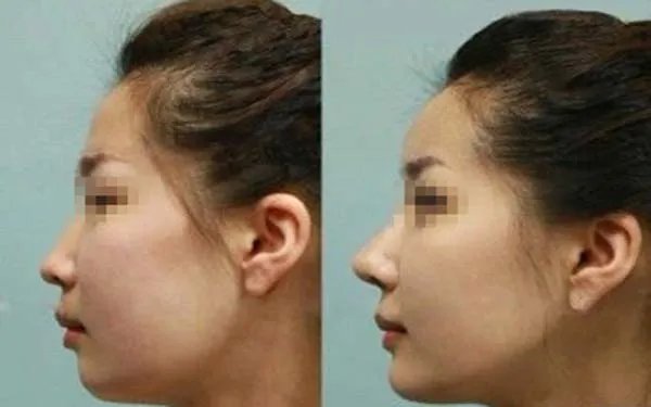 成都整形医院哪家做玻尿酸隆鼻好