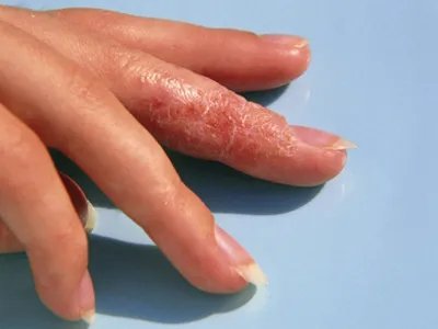 手部湿疹红斑图片