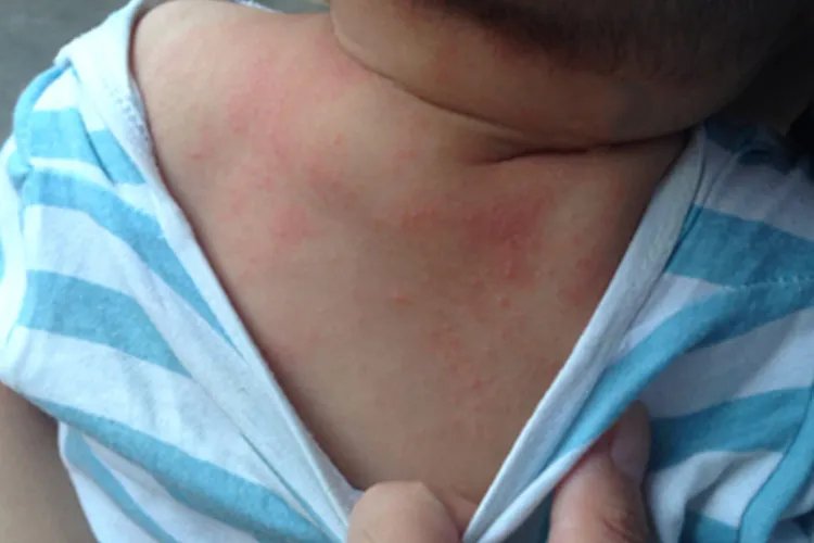 宝宝湿疹和痱子的区别图片