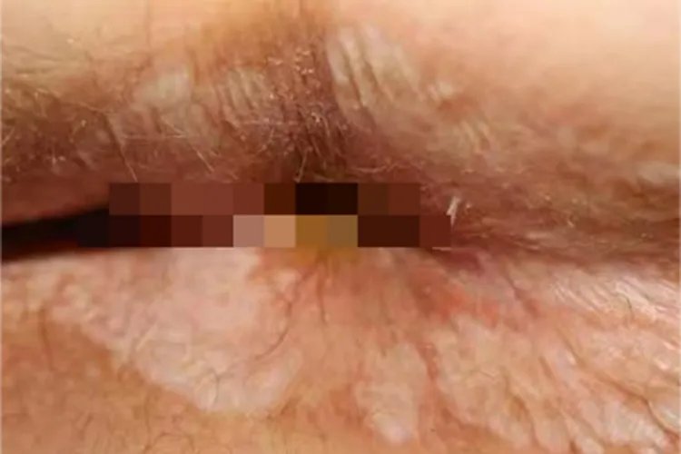 外阴白色病变症状图片