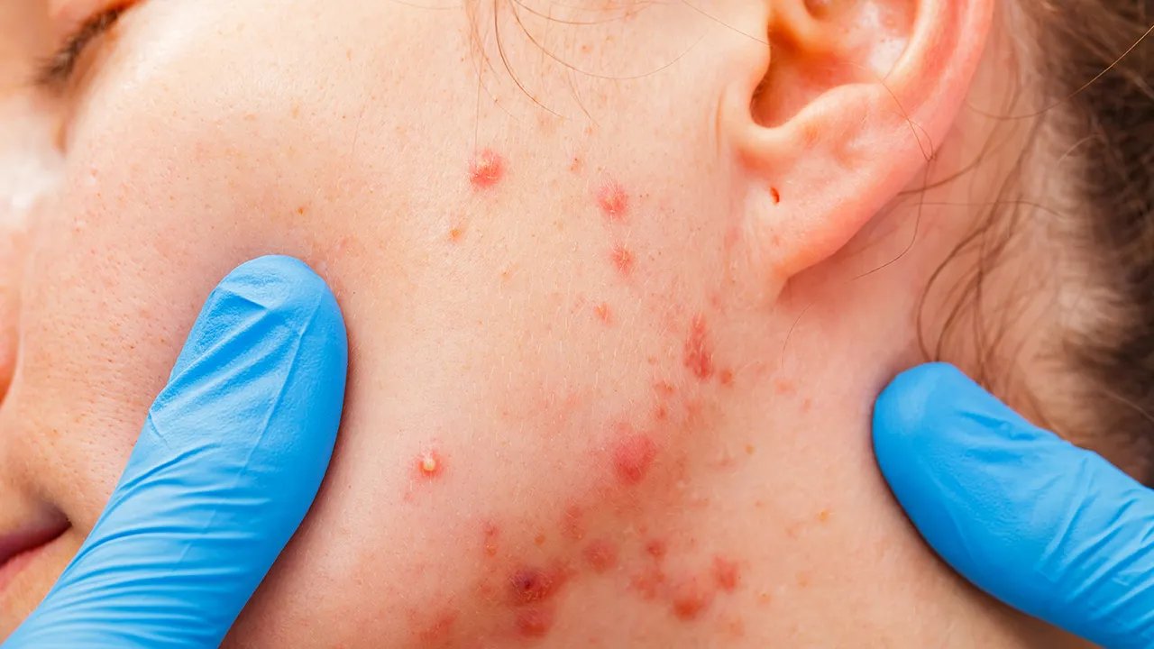 嘴巴周围长痘痘是什么原因引起的？这几种原因容易导致嘴巴周围长痘痘