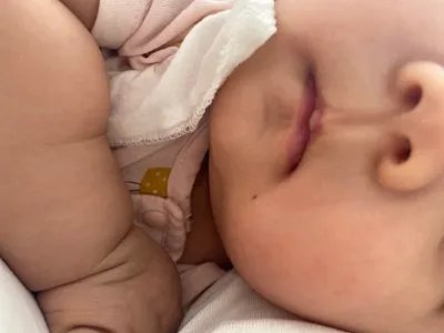 交界痣黑痣图片