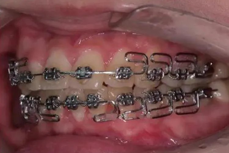 牙套分几种类型图片，有什么区别