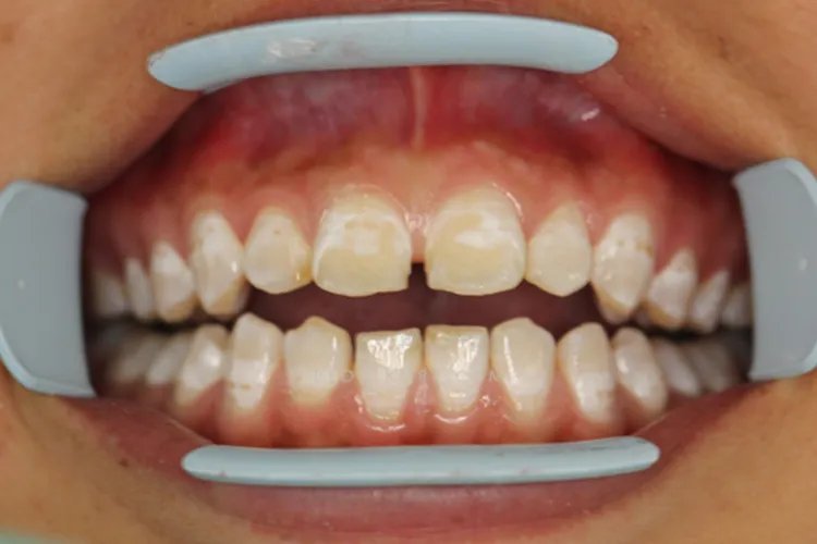 小孩四环素牙图片