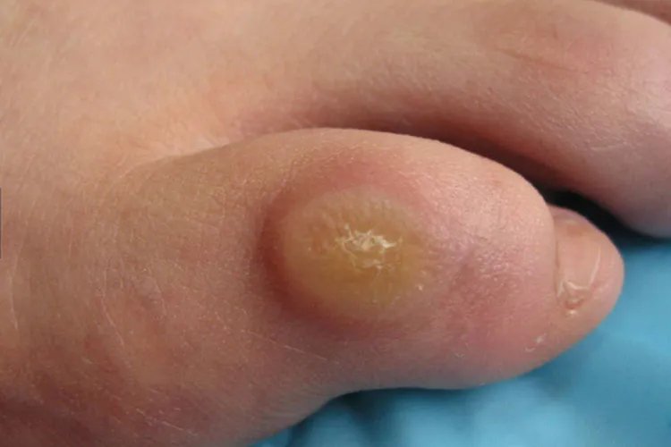脚鸡眼初期图片