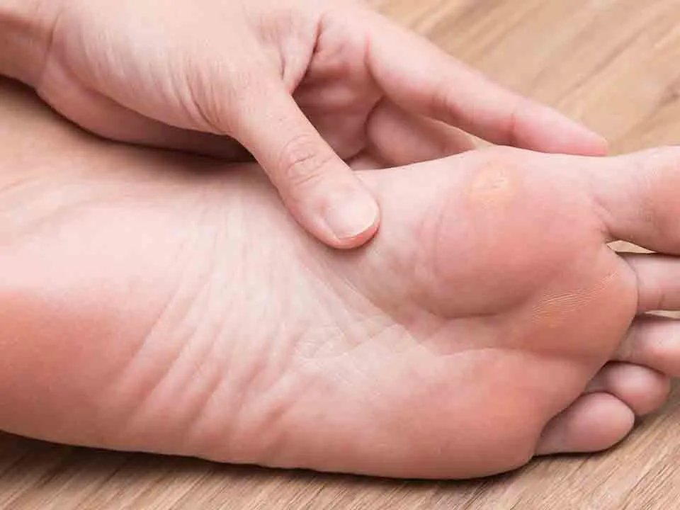 介绍鸡眼的图片是什么样