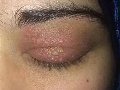 单纯疱疹水疱图片