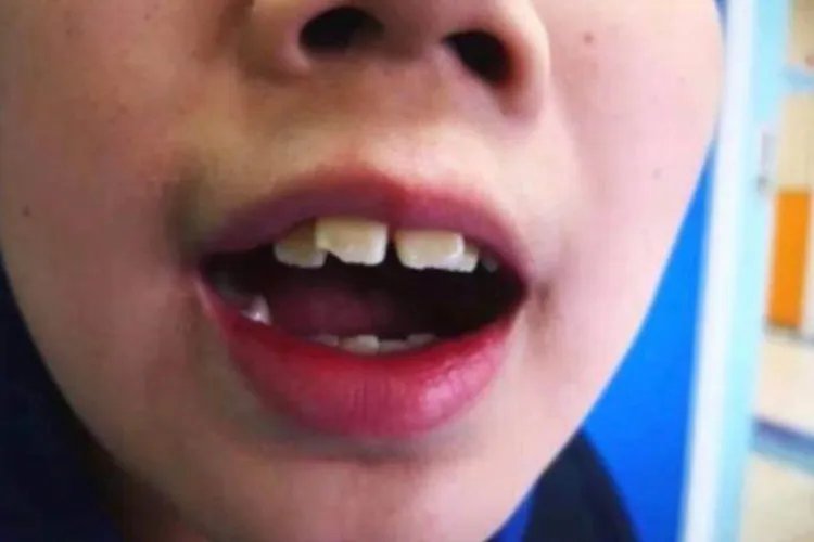 用口呼吸的危害，变丑图片