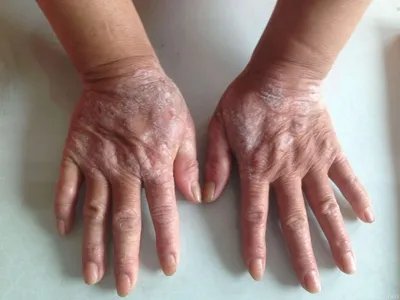 扁平苔藓斑图片