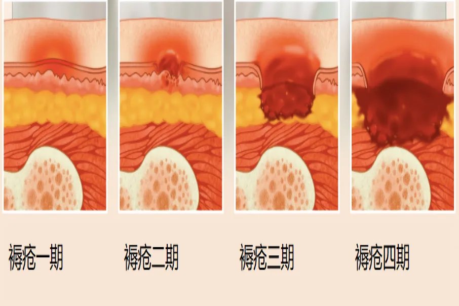 褥疮四期图片