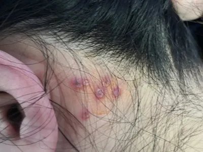 单纯疱疹水疱图片