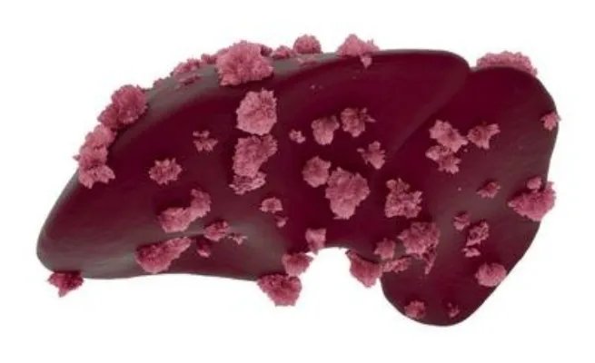 肝脏血管瘤对身体危害有哪些