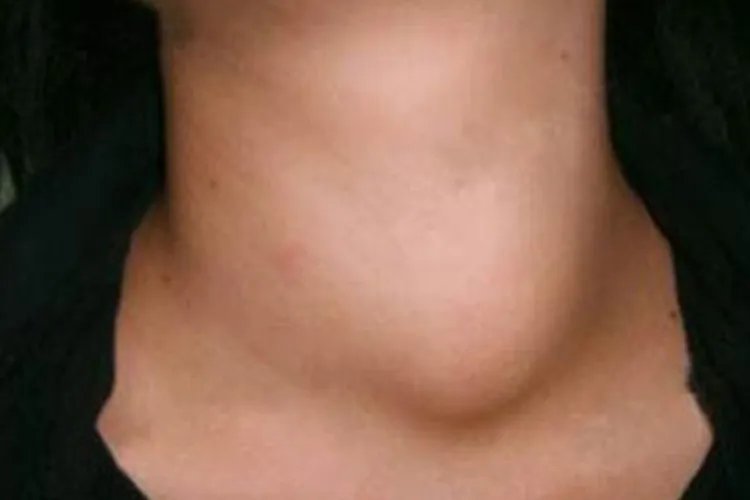 正常脖子和甲状腺肿大图片