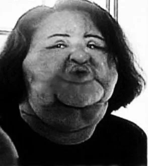 韩苗可为什么要注射食用油 韩苗可原来的样子和现状对比照