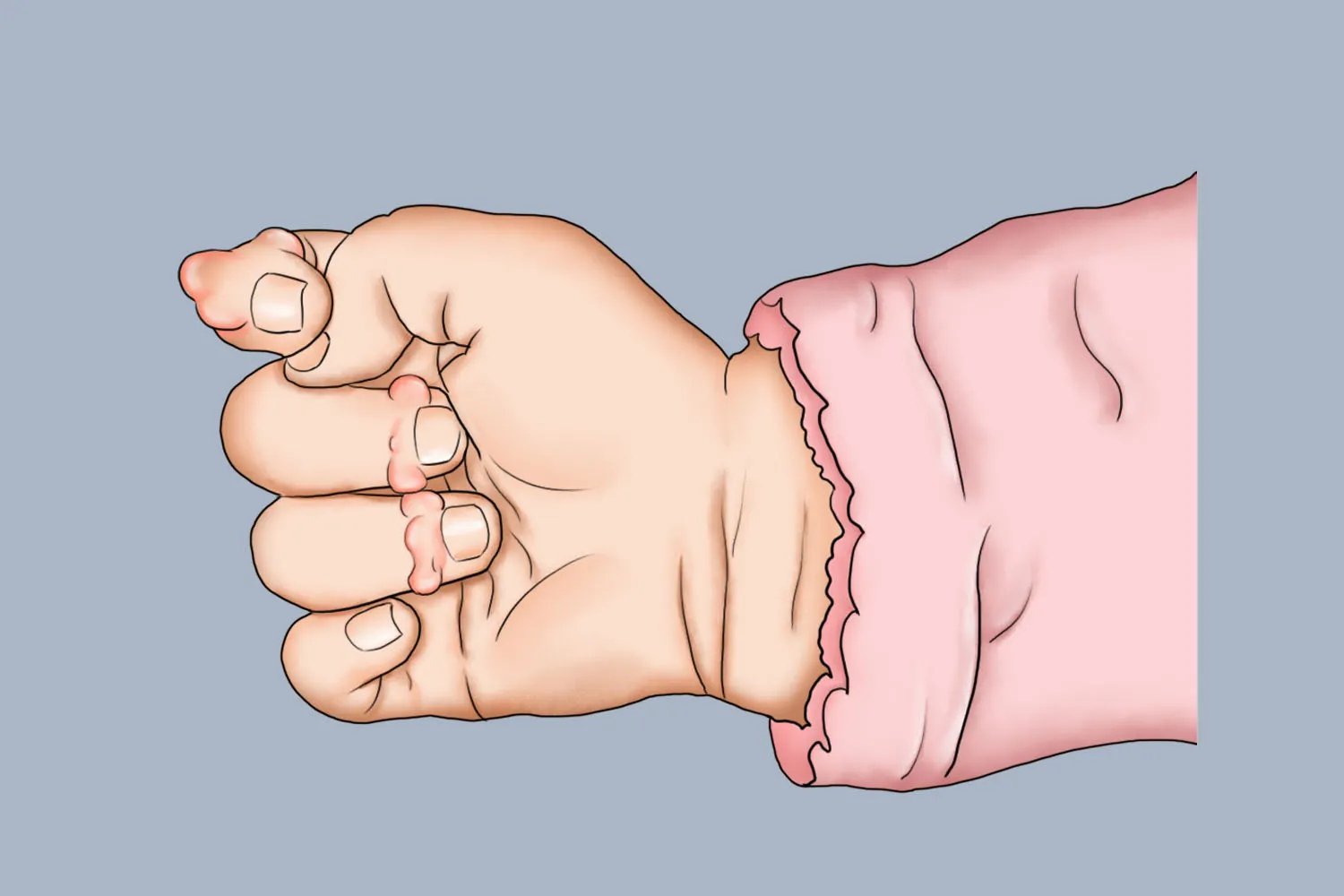 新生儿纤维瘤图片