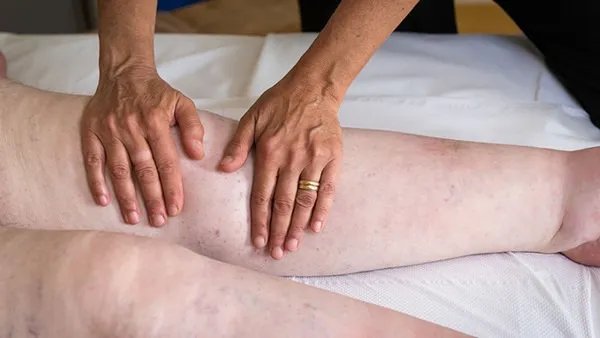 小腿浮肿怎么办