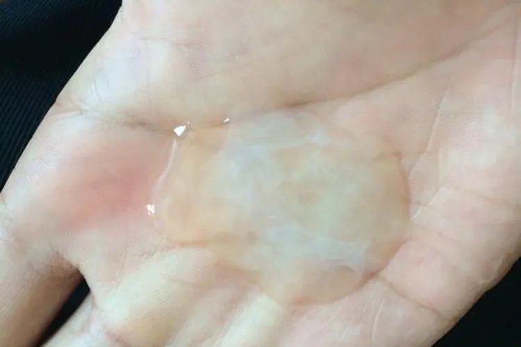 宫颈癌是什么样子实图