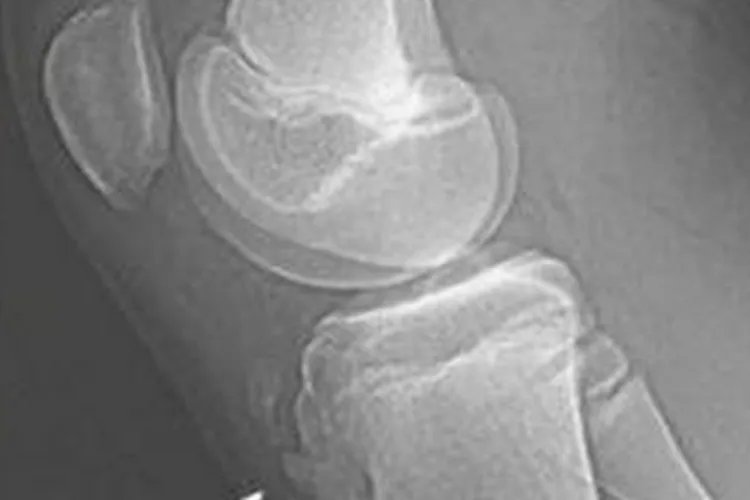 胫骨结节凸起图片