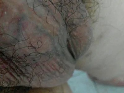 精索静脉曲张症状图片