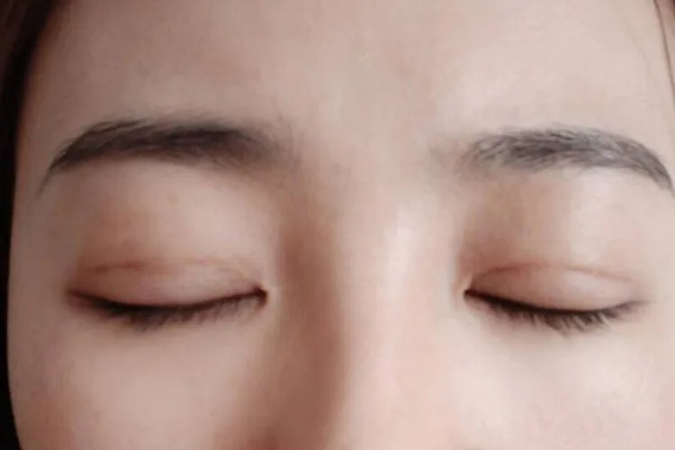 埋线双眼皮图片