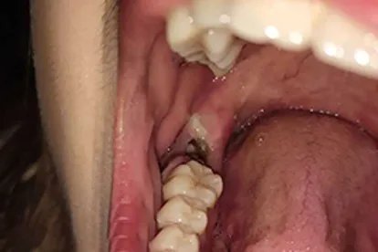 拔牙后七天窟窿恢复图