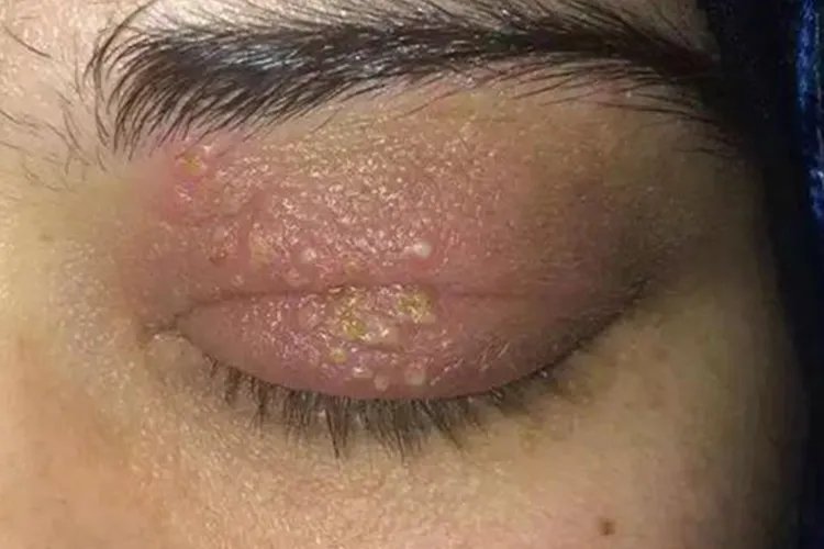 小皮疹图片大全