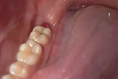 拔牙后七天窟窿恢复图