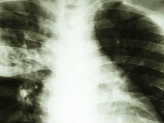 海洋创伤弧菌的感染原因