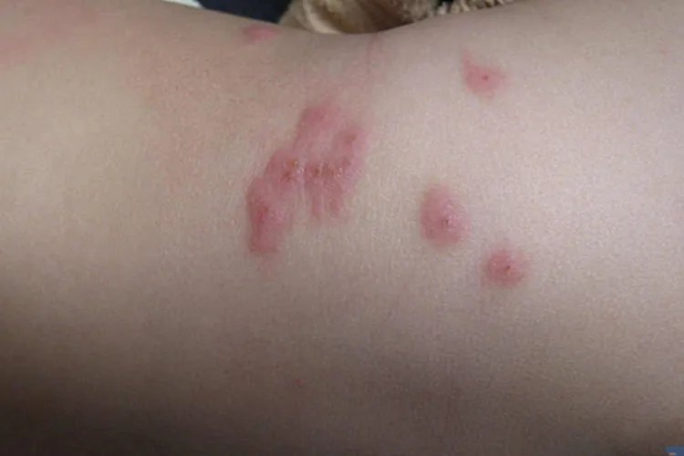 跳蚤咬的红疙瘩长什么样