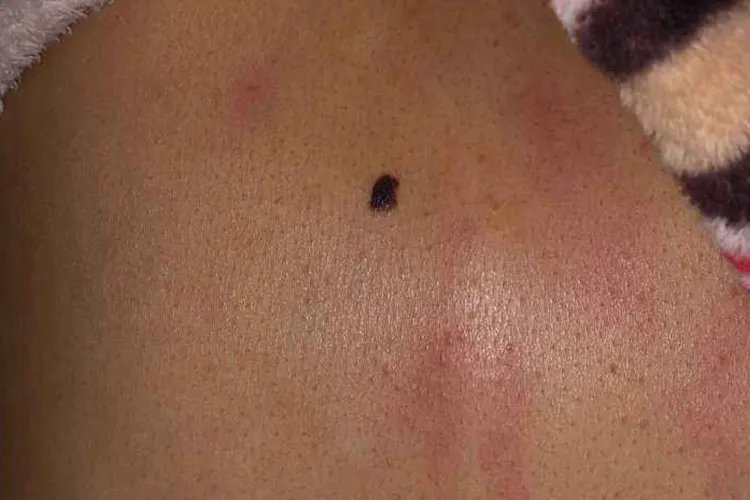 后背的黑色素瘤早期症状图片