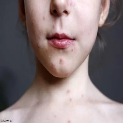 水土不服起痘痘怎么办