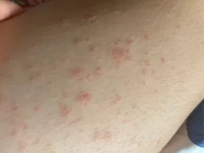 运动诱导性荨麻疹症状图片