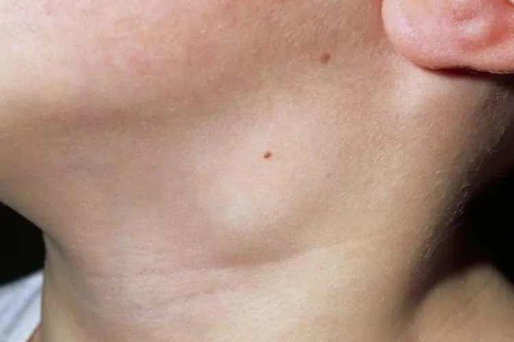 颈部淋巴结肿大图片