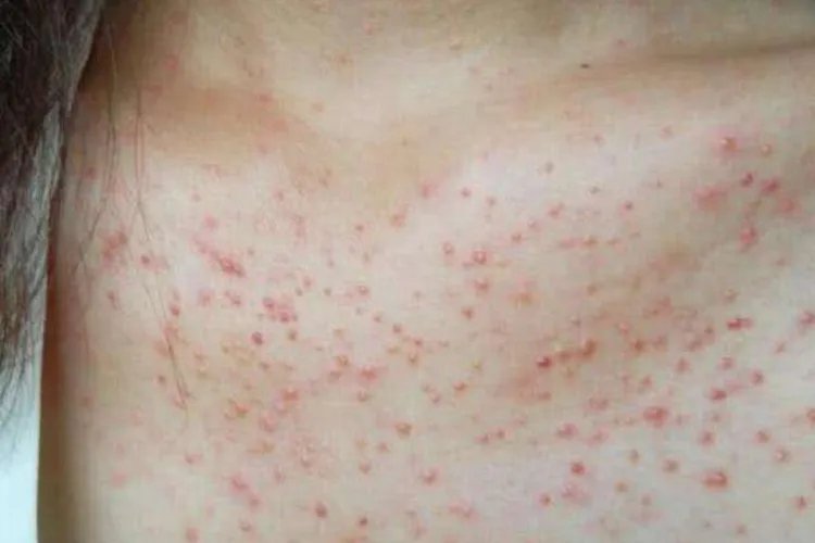 女性胸前红色凸起小痘痘图片