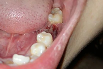 拔牙后七天窟窿恢复图