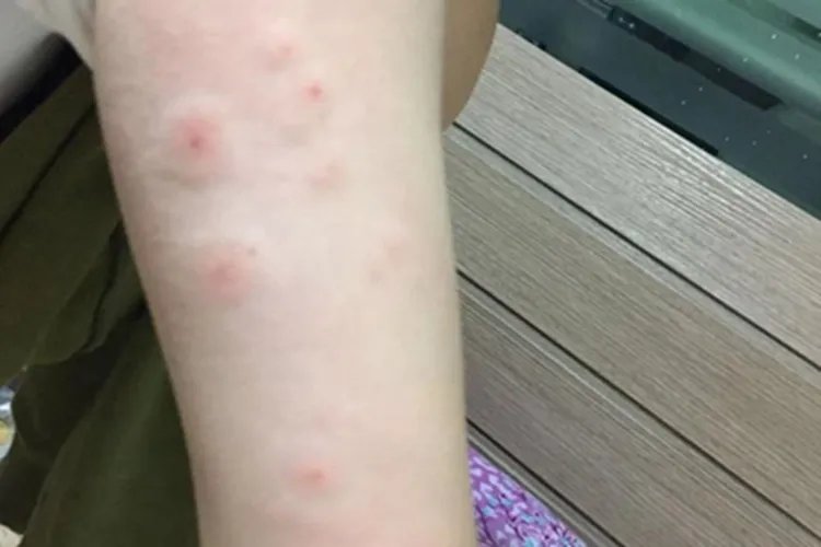 跳蚤叮咬红点图片