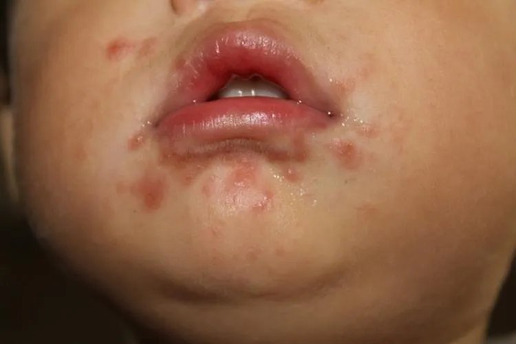 什么是手足口病图片