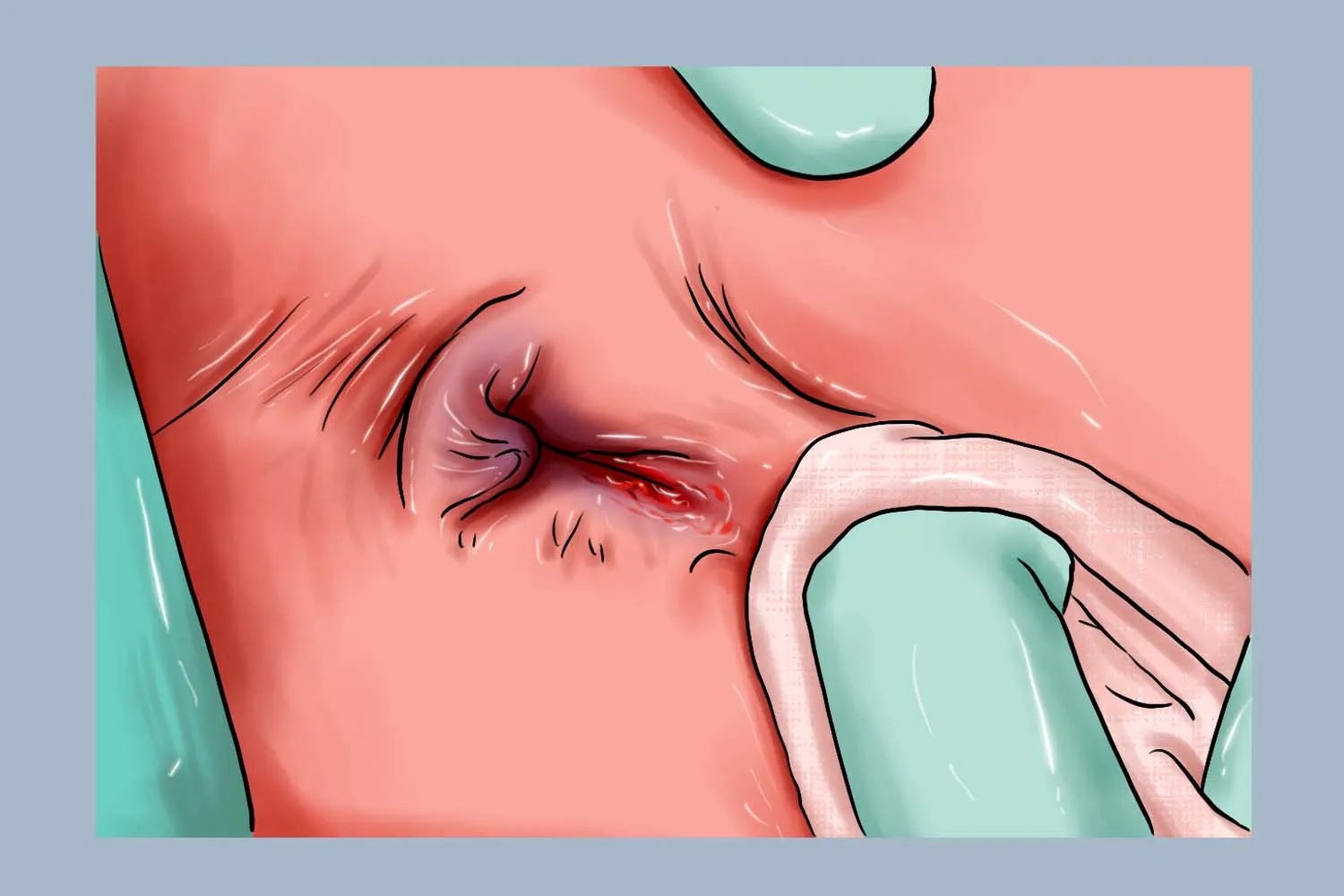 肛裂真实图片大全