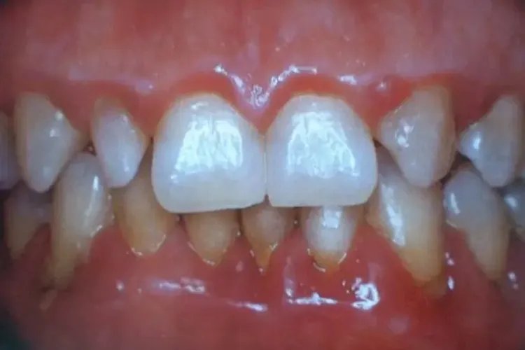 牙周病图片与正常牙齿图片