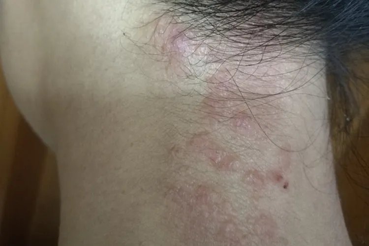 脖子上花斑癣图片大全