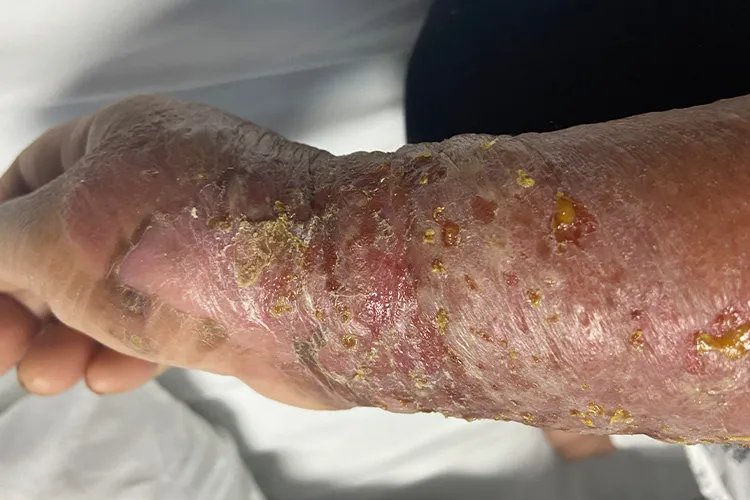 皮肤病湿疹对照图片