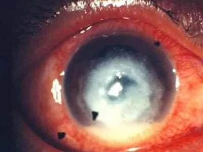 真菌性角膜炎症状图片