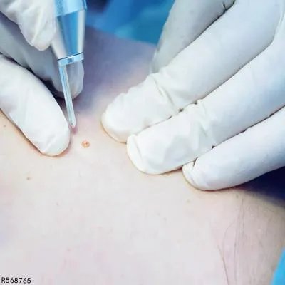 手上长痣怎么去掉呢