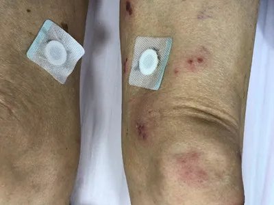 单纯疱疹水疱图片