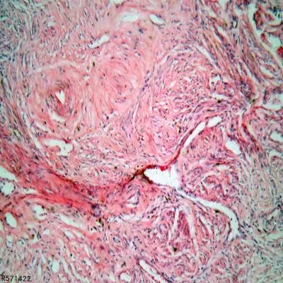 怎么预防脊索瘤